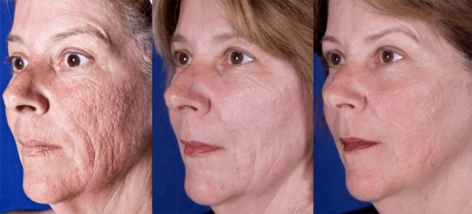 The result after the laser skin rejuvenation procedure