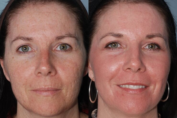 before and after skin rejuvenation hardware